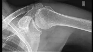 Vaccination Injury