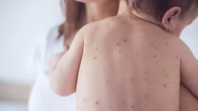 Measles, Mumps, Rubella (MMR) Vaccine