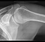 Vaccination Injury
