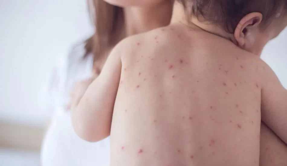 Measles, Mumps, Rubella (MMR) Vaccine
