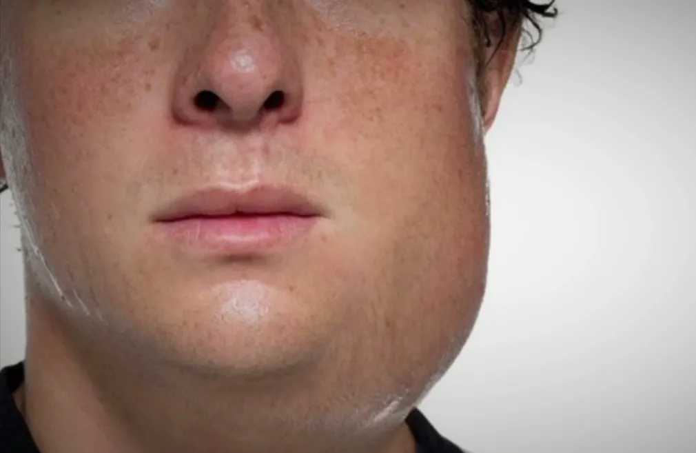 MMR-2-Mumps-img