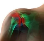Rotator Cuff Tears and Shoulder Injury Related to Vaccine Administration