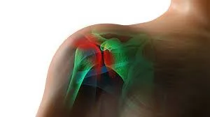 Rotator Cuff Tears and Shoulder Injury Related to Vaccine Administration