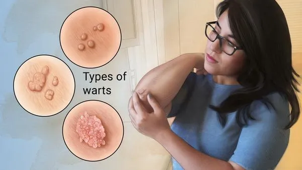 Hpv Warts Image