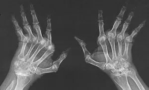 Rheumatoid Arthritis