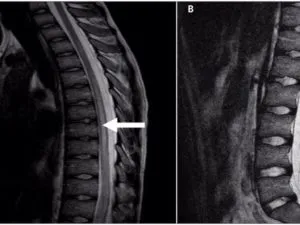 Transverse Myelitis Image